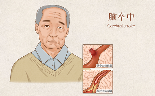 動脈硬化檢測儀